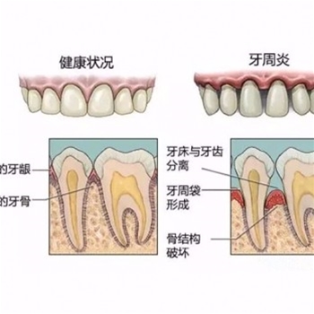 牙周病