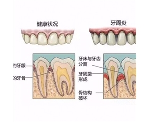 牙周病
